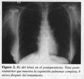Rx del Tórax en el Postoperatorio