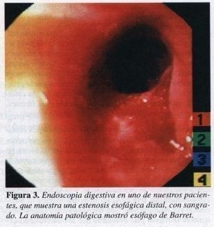Endoscopia Digestiva en uno de nuestros Pacientes