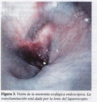 Visión de la Miotomía Esofágica Endoscópica