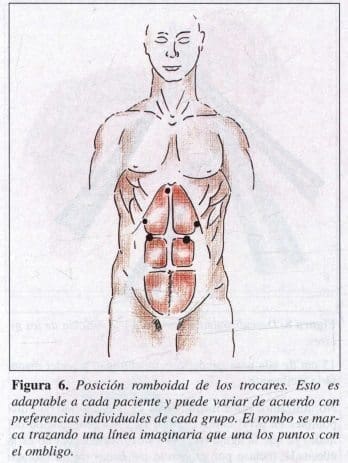 Posición Romboidal de los Trocares