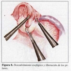 Descubrimiento Esofágico y Liberación de los Pilares