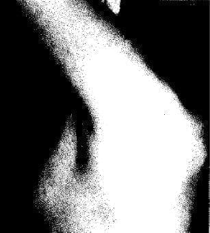 Paciente con agonadismo XY