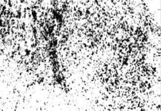 Falla ovárica prematura