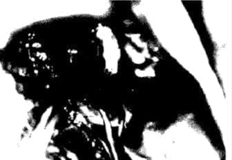 Gónada atrésica a la laparoscopía