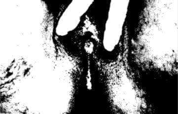 Hiperplasia suprarrenal congénita