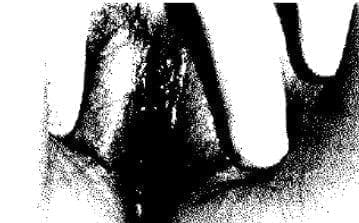 Genitales externos femeninos infantiles