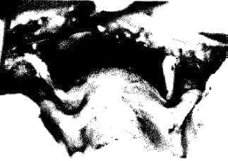 Útero y trompas a la laparotomia