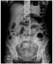 Disten­sión de asas intestinales