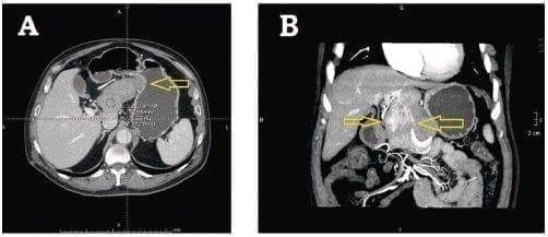 Tumor fibroso solitario del hígado