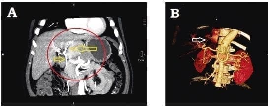 Irrigación arterial del tumor hepático