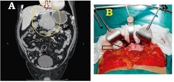 Tumor fibroso solitario