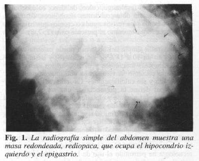 Abdomen muestra una Masa Redondeada, Rediopaca