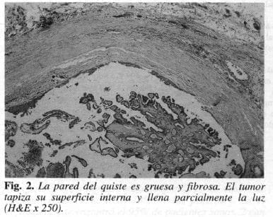 La Pared del Quiste es Gruesa y Fibrosa La Pared del Quiste es Gruesa y Fibrosa