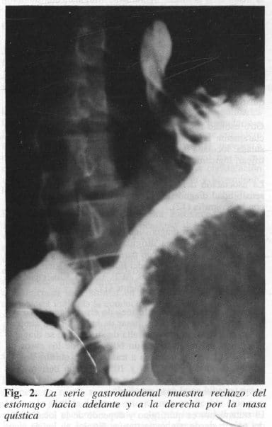 Rechazo del Estómago por la Masa Quística Rechazo del Estómago por la Masa Quística