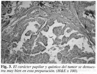 Carácter Papilar y Quístico del Tumor Carácter Papilar y Quístico del Tumor