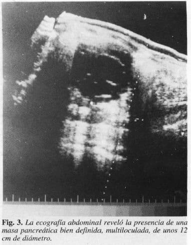 Presencia de una Masa Pancreática Bien Definida Presencia de una Masa Pancreática Bien Definida
