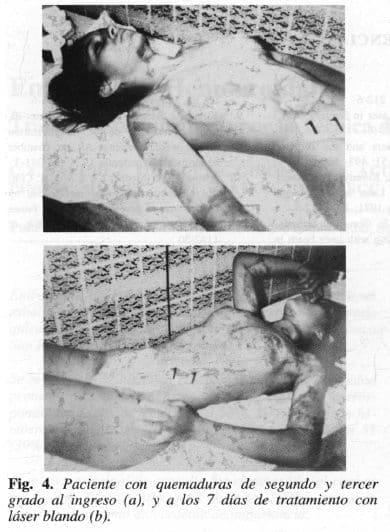 Paciente con Quemaduras de segundo y tercer grado Paciente con Quemaduras de segundo y tercer grado