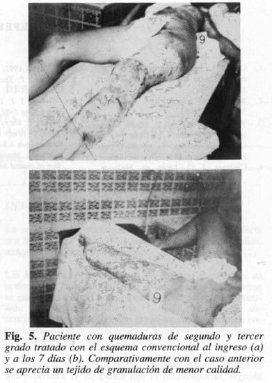 Tejido de Granulación de Menor Calidad Tejido de Granulación de Menor Calidad