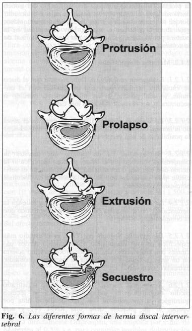 Hernia Discal Intervertebral