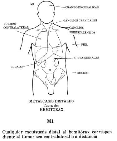 Metástasis Distal al Hemitórax Metástasis Distal al Hemitórax