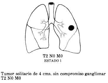 Compromiso Ganglionar Compromiso Ganglionar