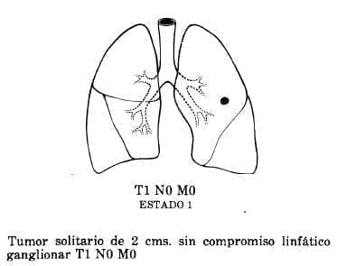 Compromiso Linfático Ganglionar Compromiso Linfático Ganglionar