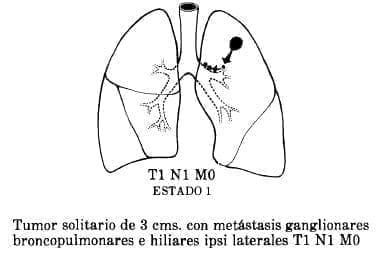 Metástasis Ganglionares Broncopulmonares  Metástasis Ganglionares Broncopulmonares