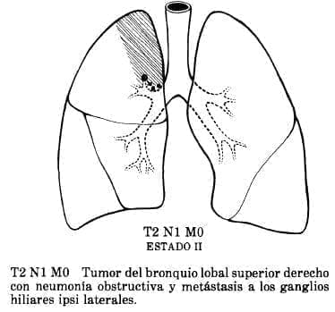 Neumonía Obstructiva y Metástasis Neumonía Obstructiva y Metástasis