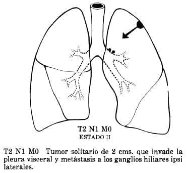Pleura Visceral y Metástasis a los ganglios hiliares ipsi Laterales Pleura Visceral y Metástasis a los ganglios hiliares ipsi Laterales