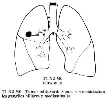 Metástasis a los Ganglios Hiliares y Mediastinales Metástasis a los Ganglios Hiliares y Mediastinales