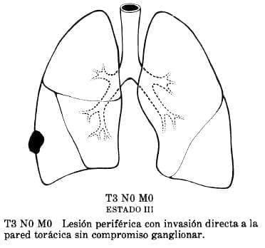 Lesión periférica con invasión directa a la Pared Torácica Lesión periférica con invasión directa a la Pared Torácica