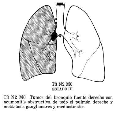 Tumor del Bronquio Tumor del Bronquio