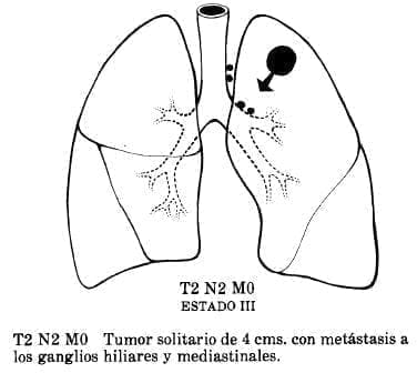 Tumor Solitario de 4 cms. con Metástasis Tumor Solitario de 4 cms. con Metástasis