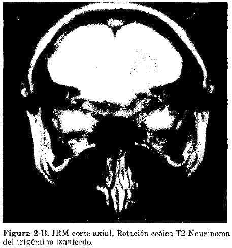Rotación ecóica T2-Neurinoma del trigémino izquierdo