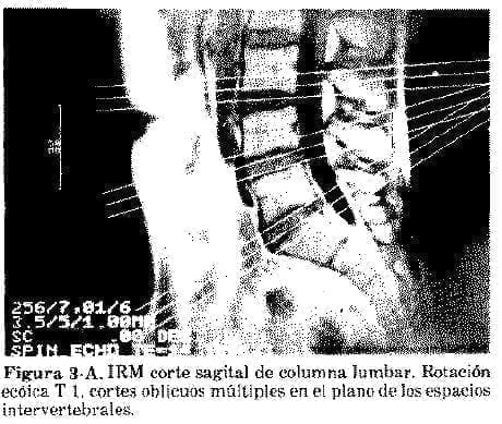 IRM corte sagital de columna lumbar