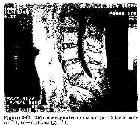IRM Corte Sagital Columna Lumbar