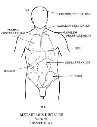 Sitios más comunes de Metástasis Distales Sitios más comunes de Metástasis Distales