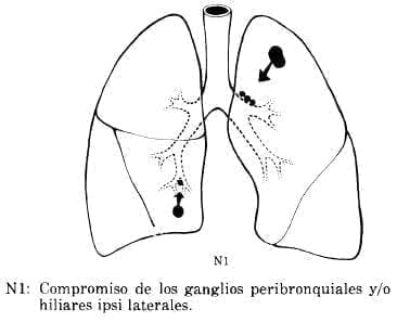 Compromiso de los Ganglios Peribronquiales Compromiso de los Ganglios Peribronquiales