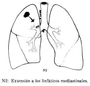 Extensión a los Linfáticos Mediastinales Extensión a los Linfáticos Mediastinales