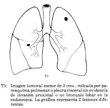 Parenquima Pulmonar o Pleura Visceral Parenquima Pulmonar o Pleura Visceral
