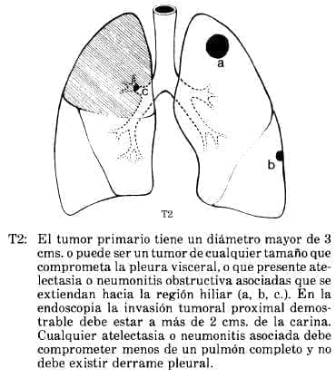 Atelectasia o Neumonitis Obstructiva asociadas que se extiendan hacia la región Hiliar Atelectasia o Neumonitis Obstructiva asociadas que se extiendan hacia la región Hiliar