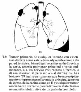 Tumor primario de cualquier tamaño Tumor primario de cualquier tamaño