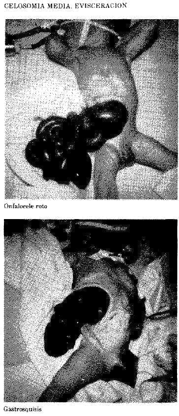 Celosomía Media: Evisceración