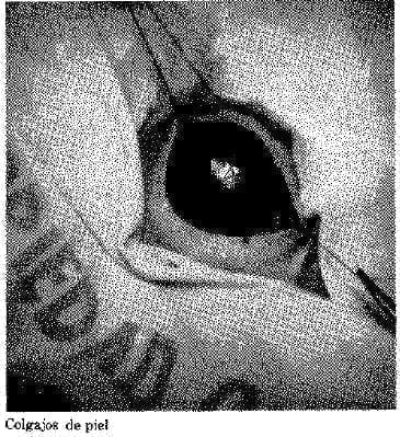 Colgajos de Piel Colgajos de Piel