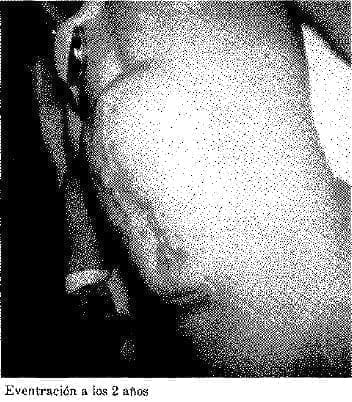 Eventración a los 2 años