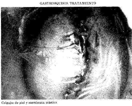 Colgajos de piel y Membrana Plástica