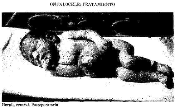 Hernia ventral Hernia ventral