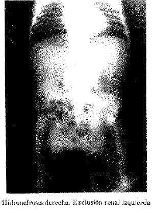 Hidronefrosis Derecha. Exclusión Renal Izquierda