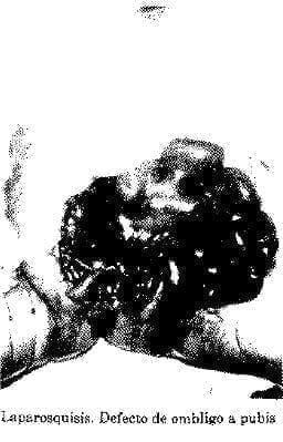 Laparosquisis. Defecto de Ombligo a Pubis