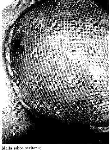 Malla sobre Peritoneo Malla sobre Peritoneo
